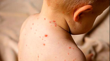 Sarampión: no se detectaron nuevos contagios y hubo provisión de vacunas