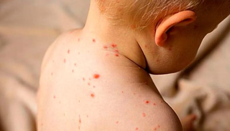 Sarampión: no se detectaron nuevos contagios y hubo provisión de vacunas